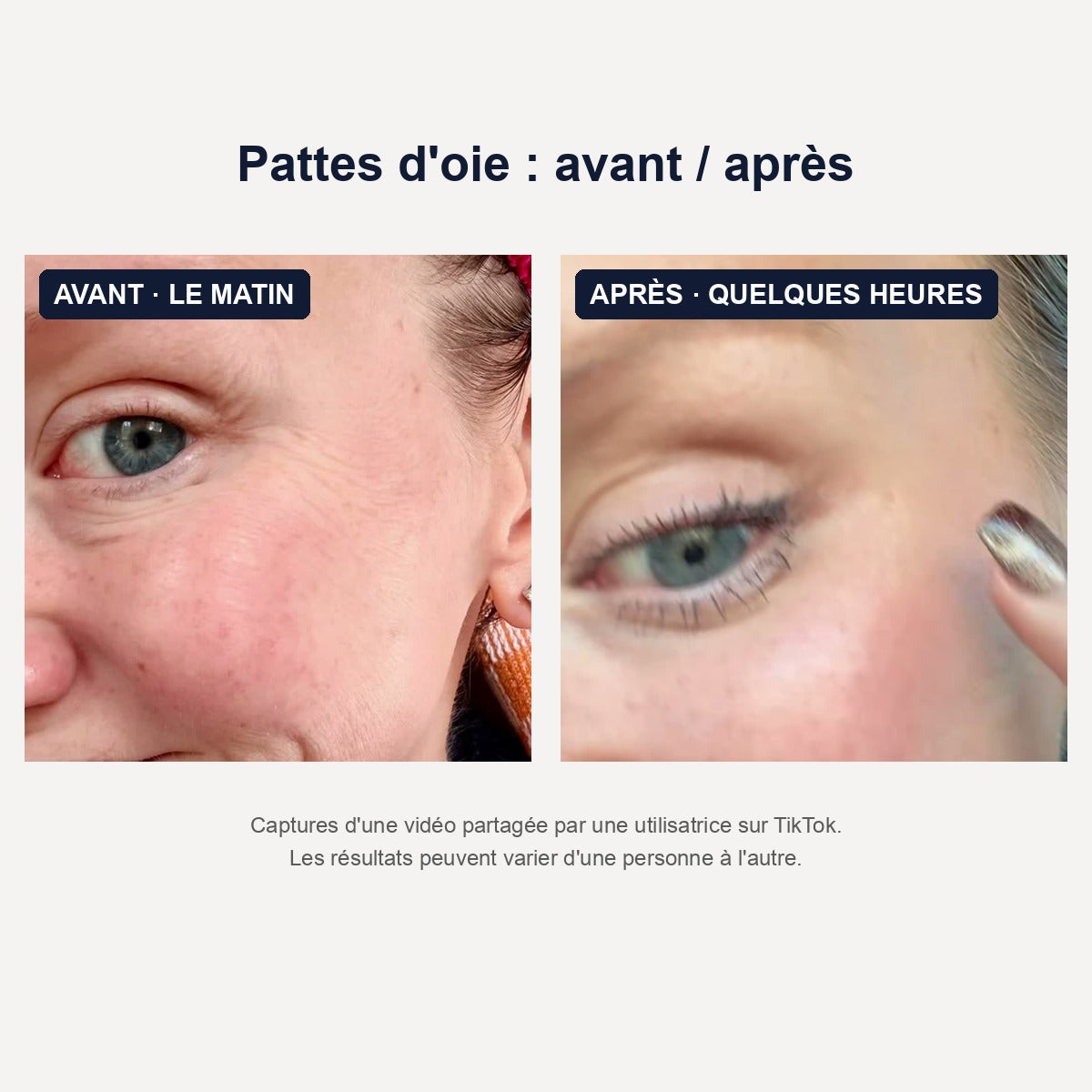 Before and after – pattes d'oie, capture TikTok