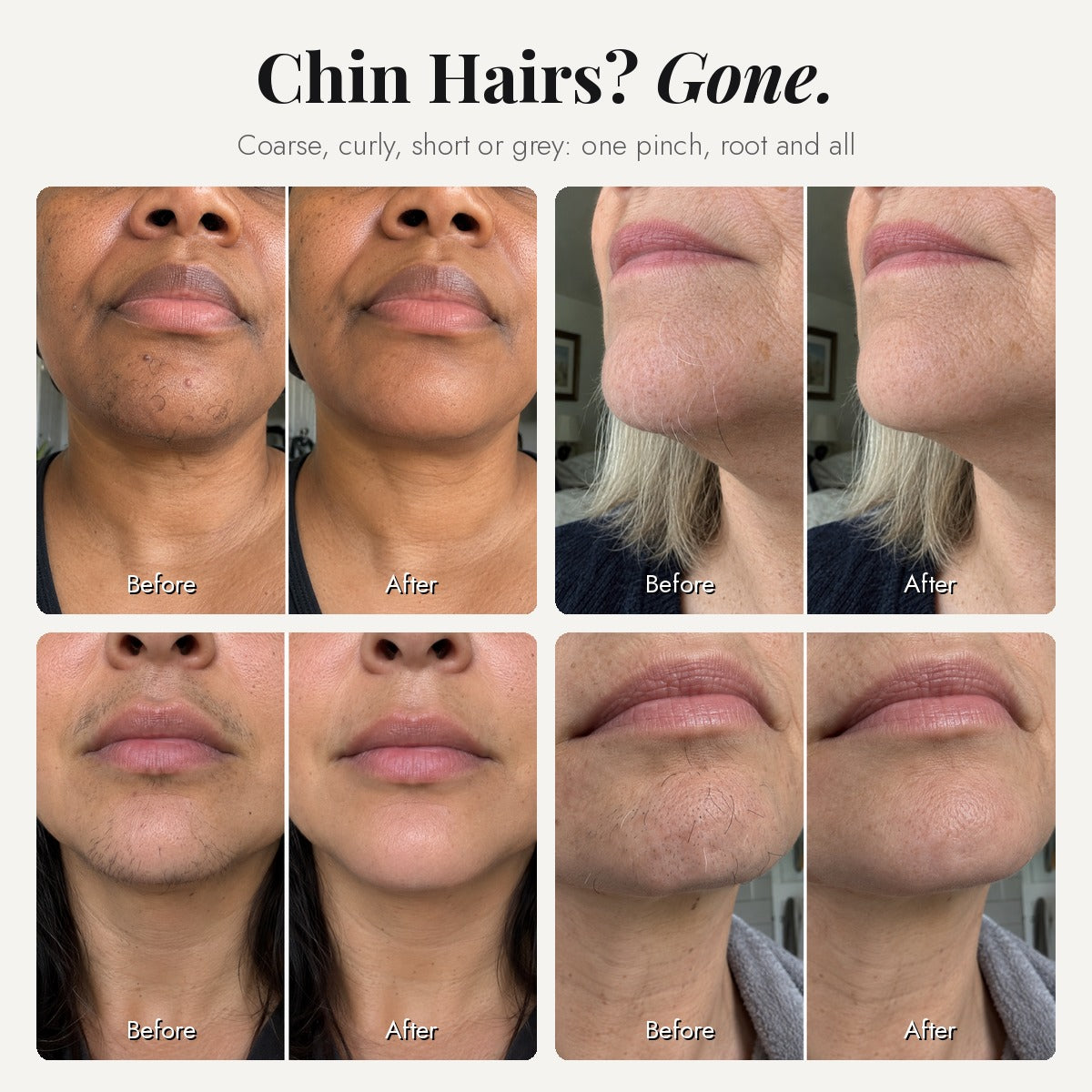 Chin hairs before and after